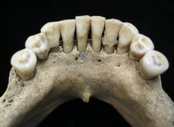 imagen de la incrustación azul en la dentadura fósil